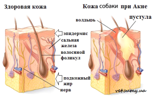 акне