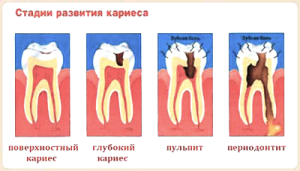 периодонтит и кариес