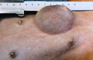 опухоль молочной железы